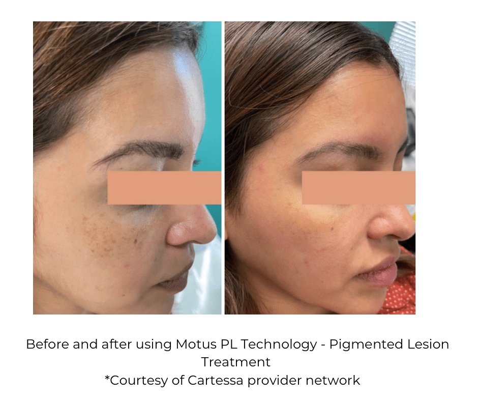 Pigmented lesions before and after - Motus AZ +