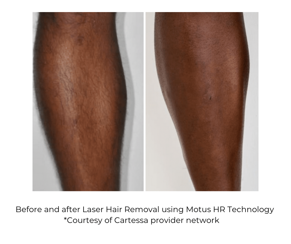 Laser hair removal before and after Motus AZ