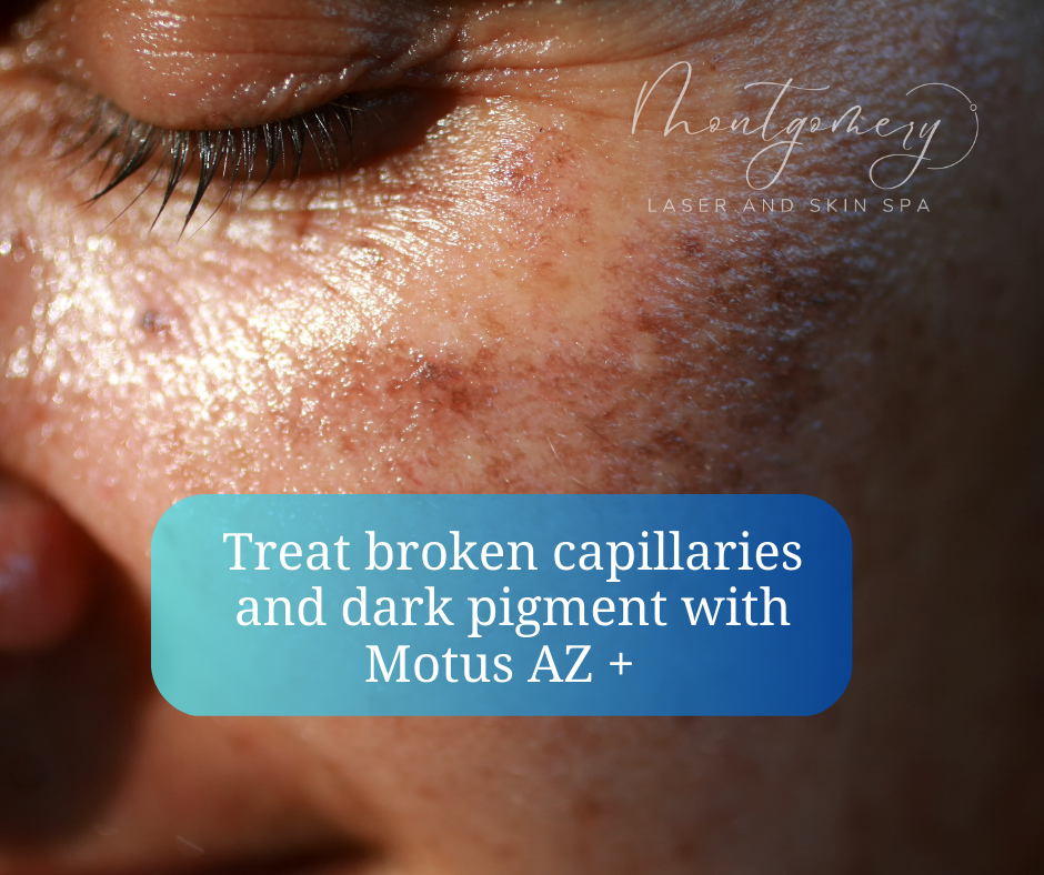 Treat broken capillaries in the face with Motus AZ +